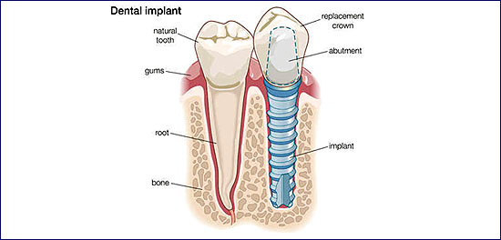 Kroatien günstige Zahnimplantate in Zahnklinik Adriatic-Dent in Rovinj